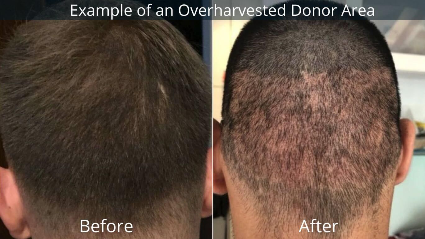Overharvested Donor Area