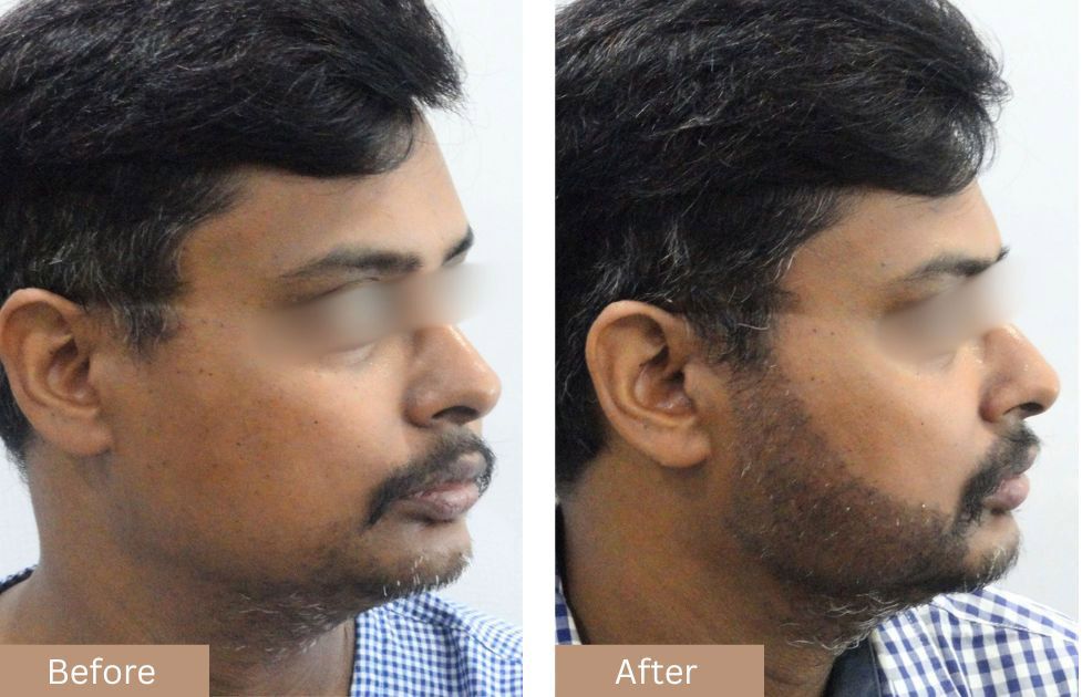 Beard Transplant Before vs After