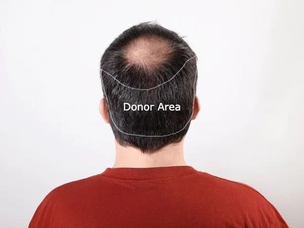 Donor Area
