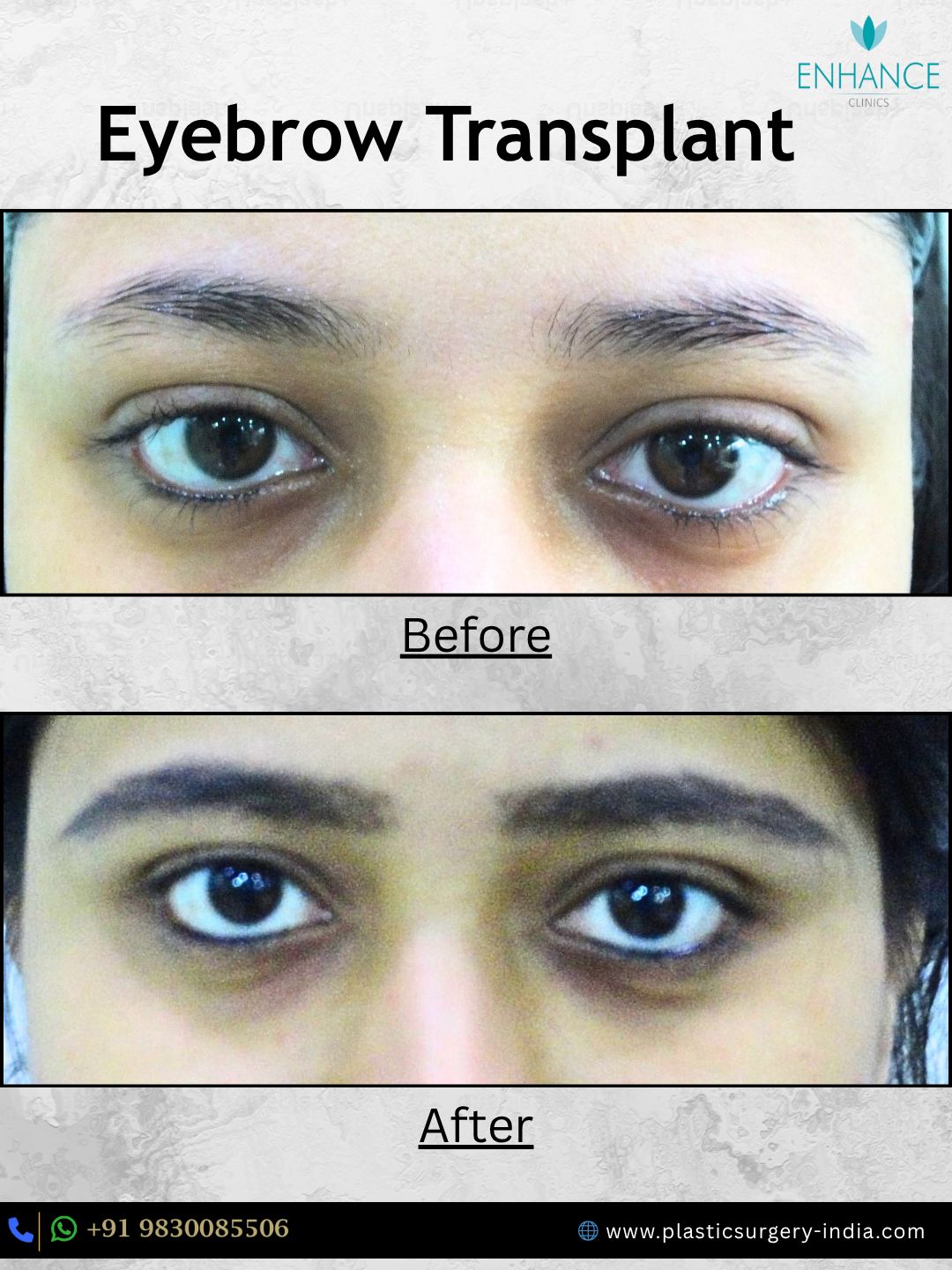 Eyebrow Hair Transplant