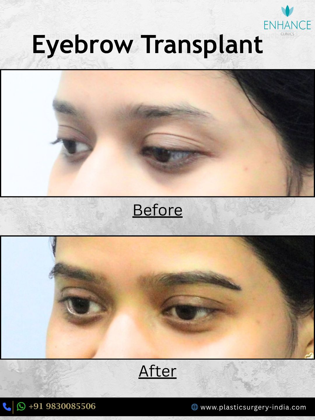 Eyebrow Transplant