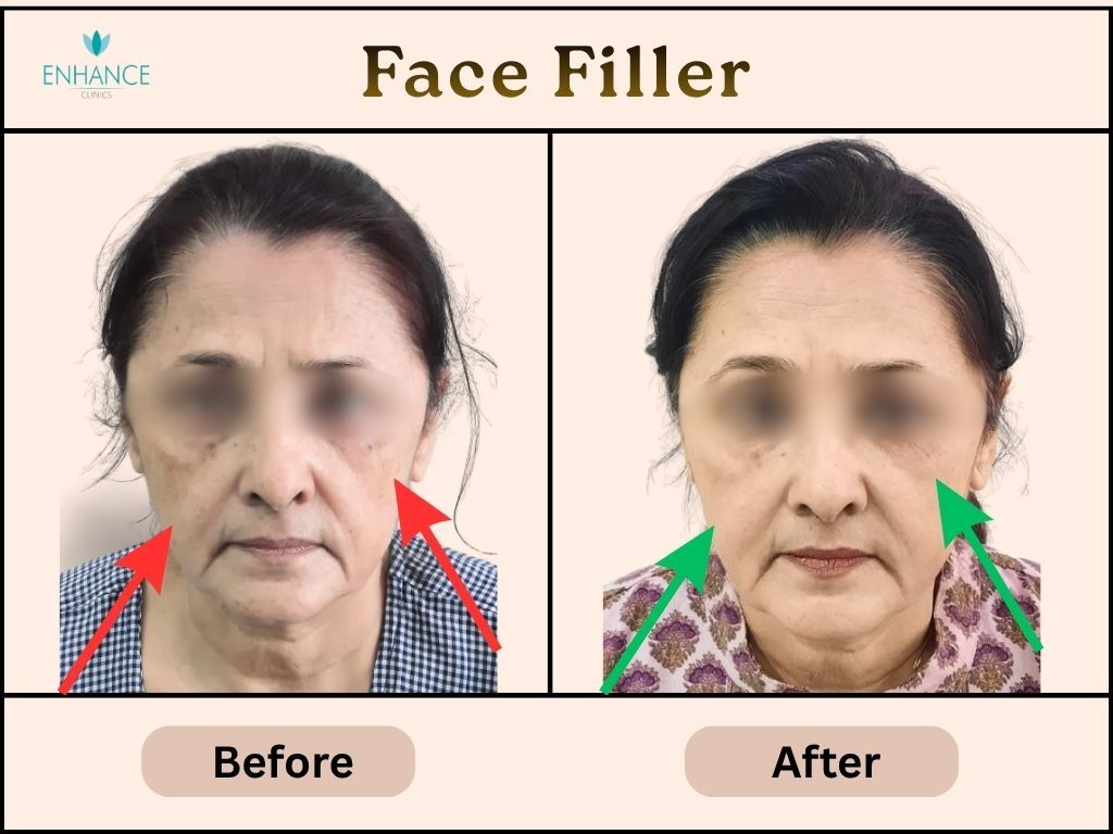 Fat fill in Kolkata