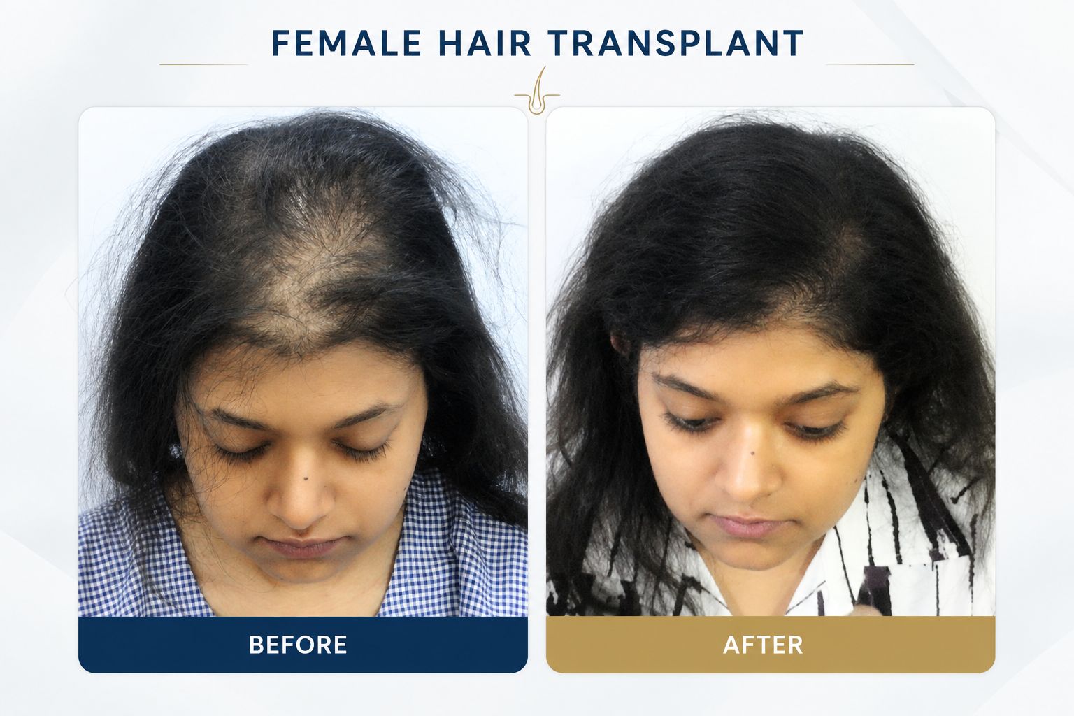 Female Hair Transplant - Before and After