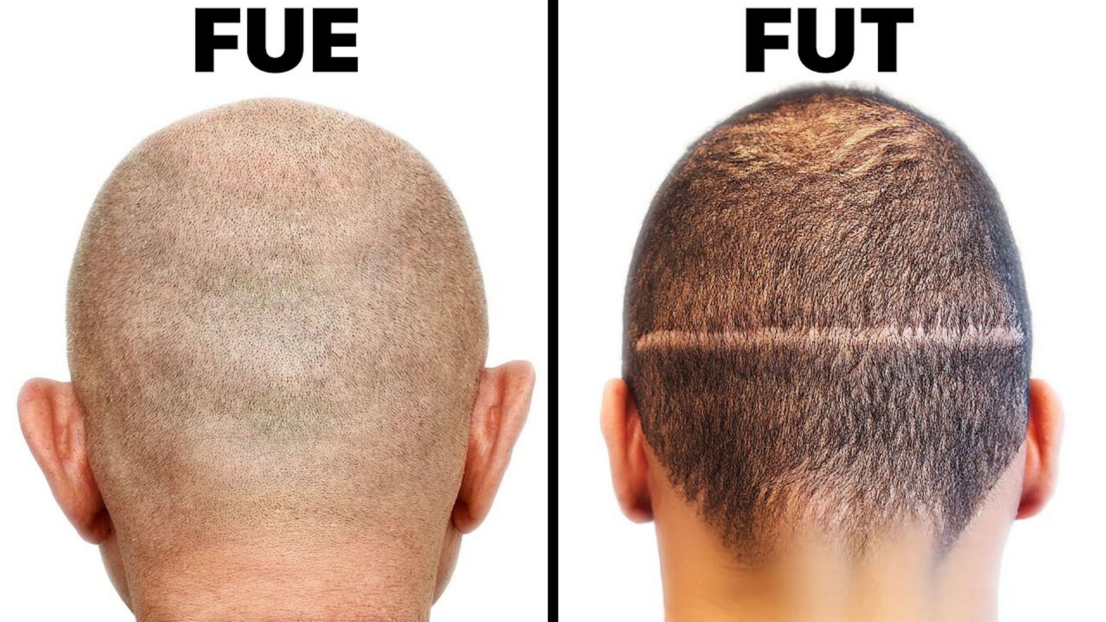 FUE vs FUT