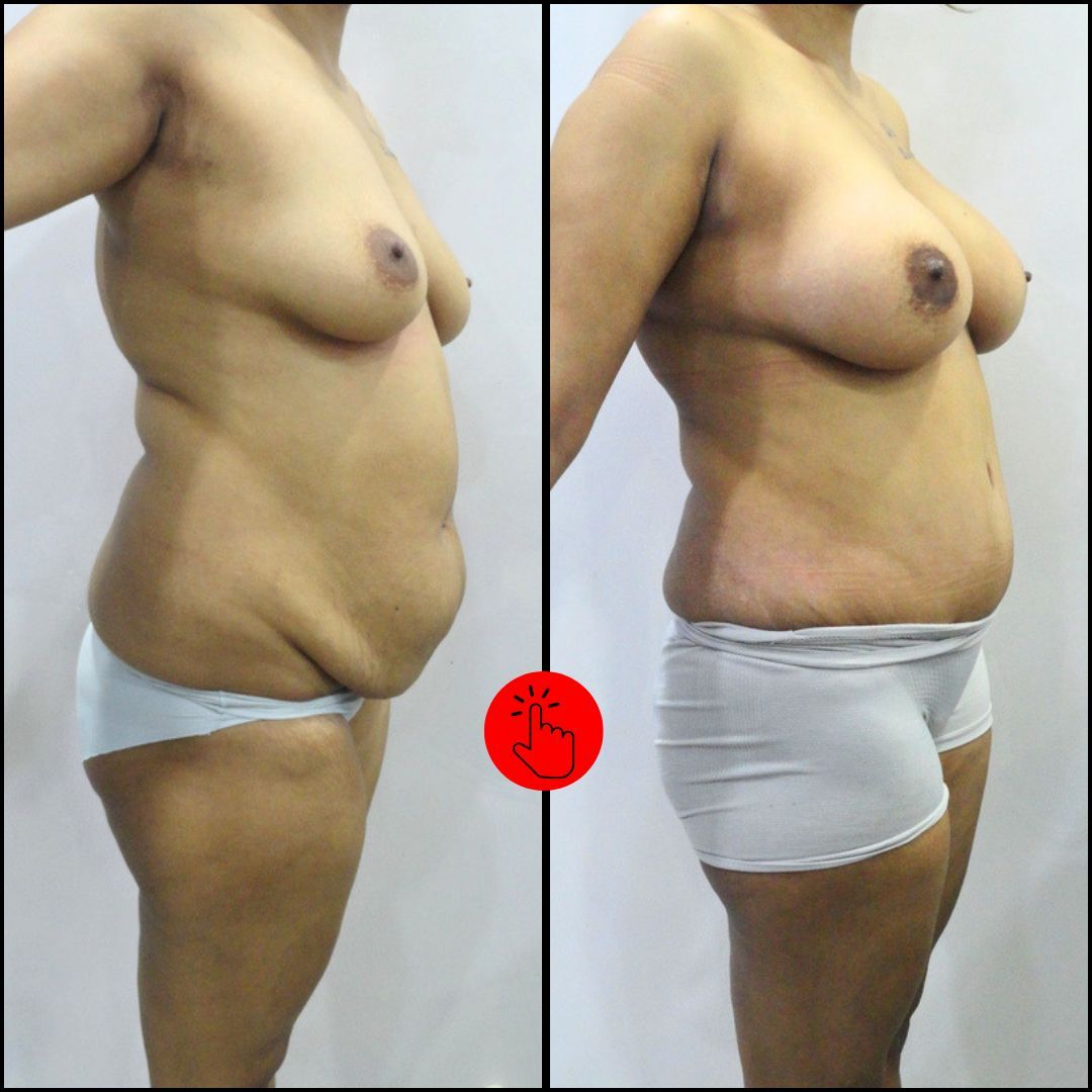 Abdominoplasty Photo Gallery