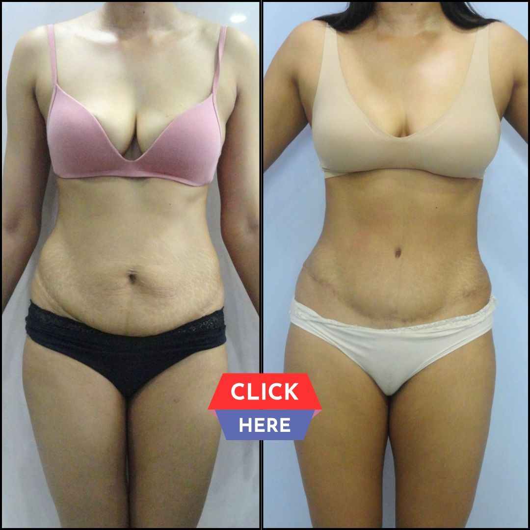 Abdominoplasty Photo Gallery