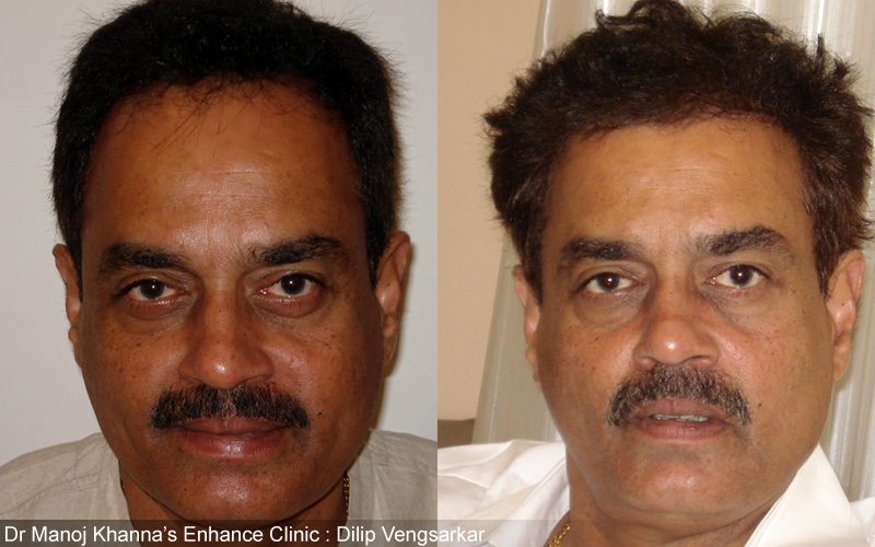 famous Hair Transplant surgeon Dr Manoj Khanna