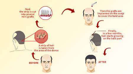 Hair Transplant Procedure