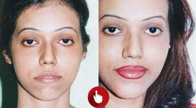 Face Surgery