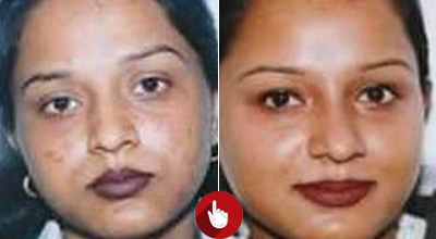 Face Surgery