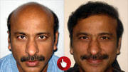 before and after hair transplant
