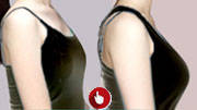 before and after breast surgery