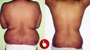before and after liposuction